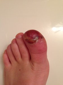 Days later, all this peeled off and my toe looks pretty normal now. Isn't it so gross?!